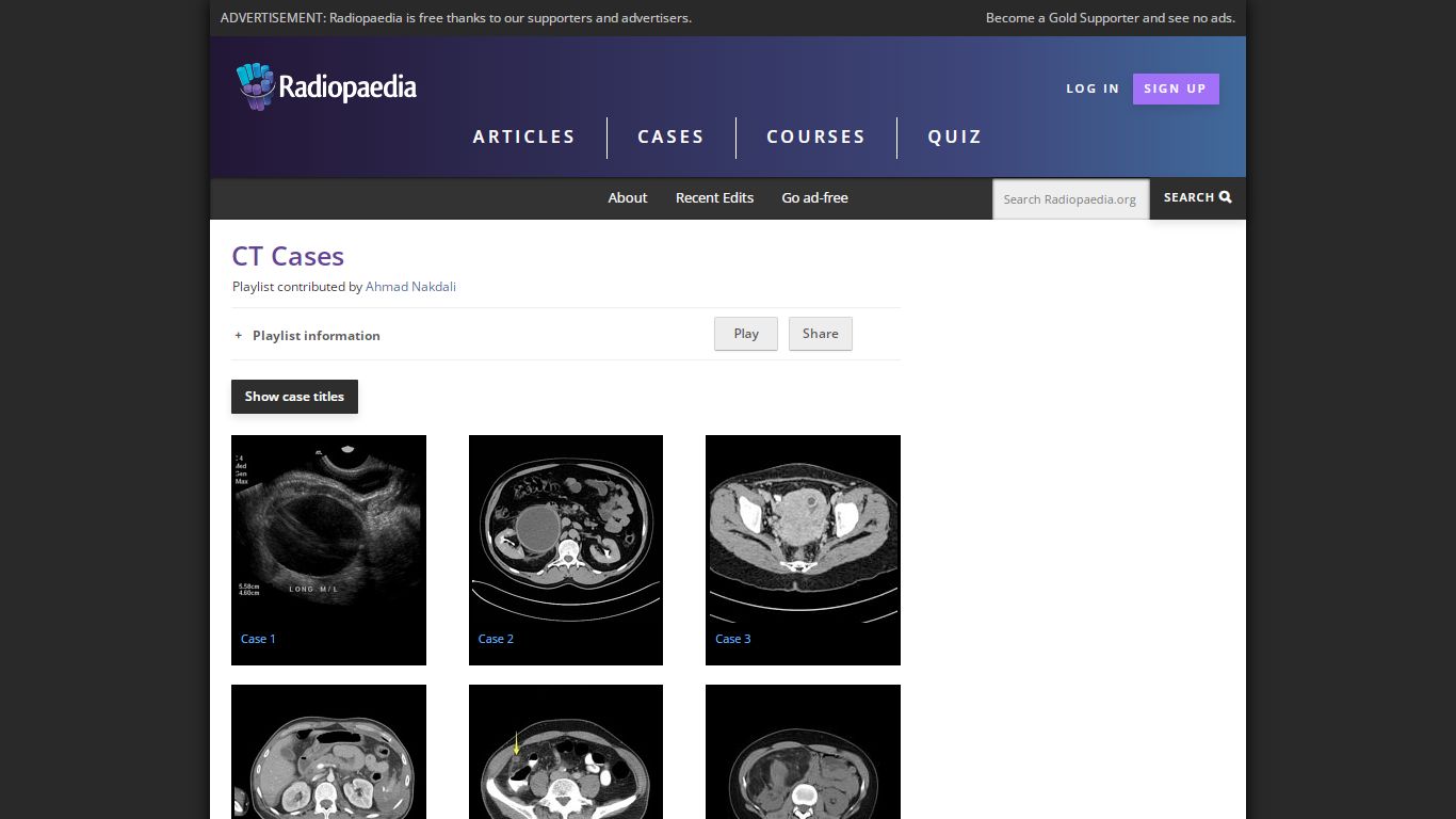 Viewing playlist: CT Cases | Radiopaedia.org